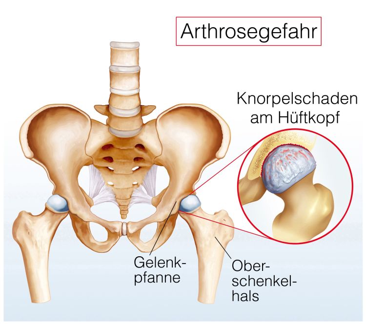 Wie entsteht ein Knorpelschaden am Hüftgelenk durch Arthrose? Behandlung durch eine Hüft-OP in Darmstadt.